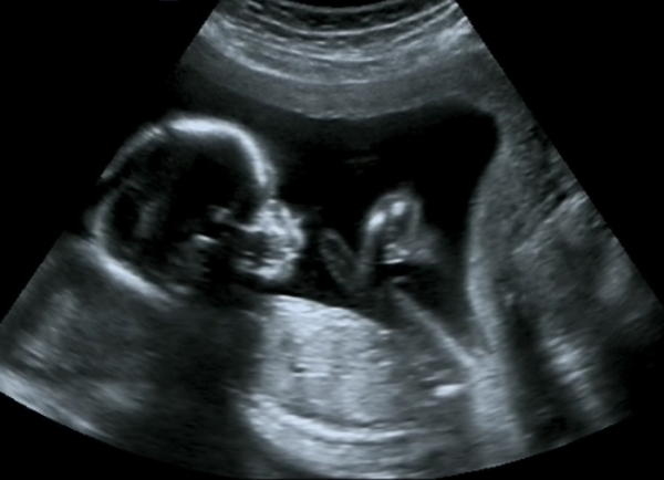 超声波里的胎儿图片