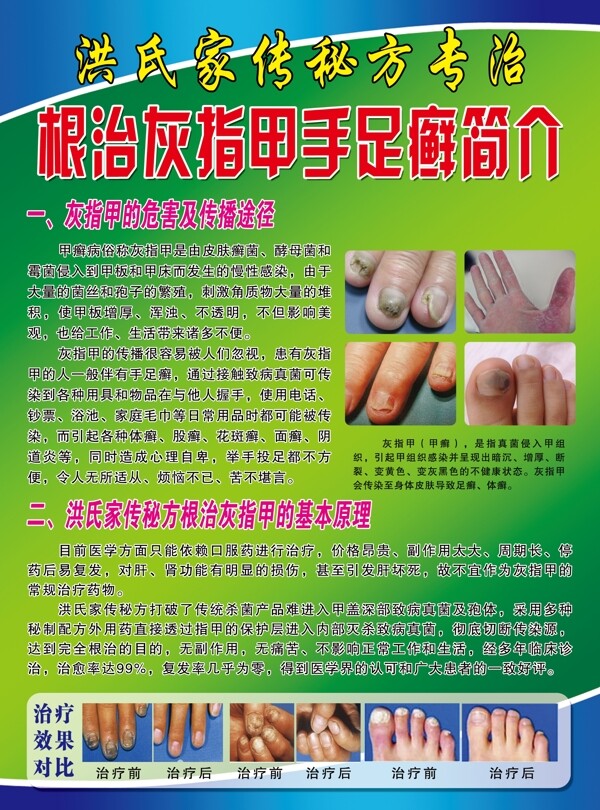 灰指甲宣傳單圖片