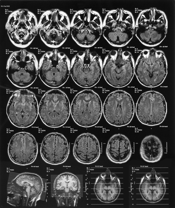 大脑的X线计算机断层扫描