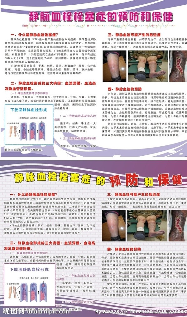 预防血栓图片