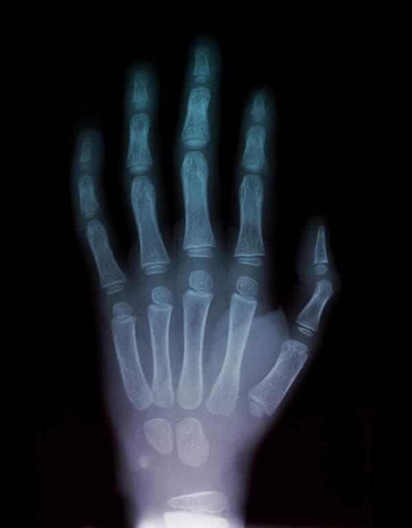 张开的手掌X光照片图片
