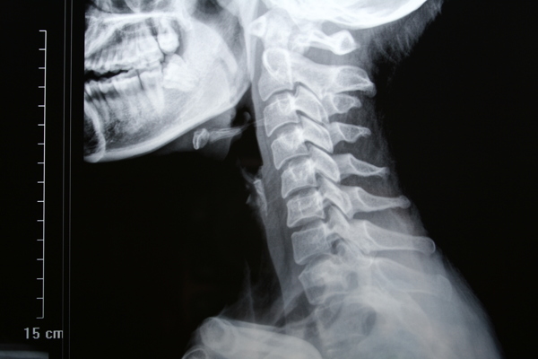 颈椎弧弓变直病实例图片