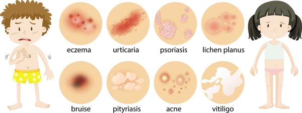 卡通儿童和皮炎